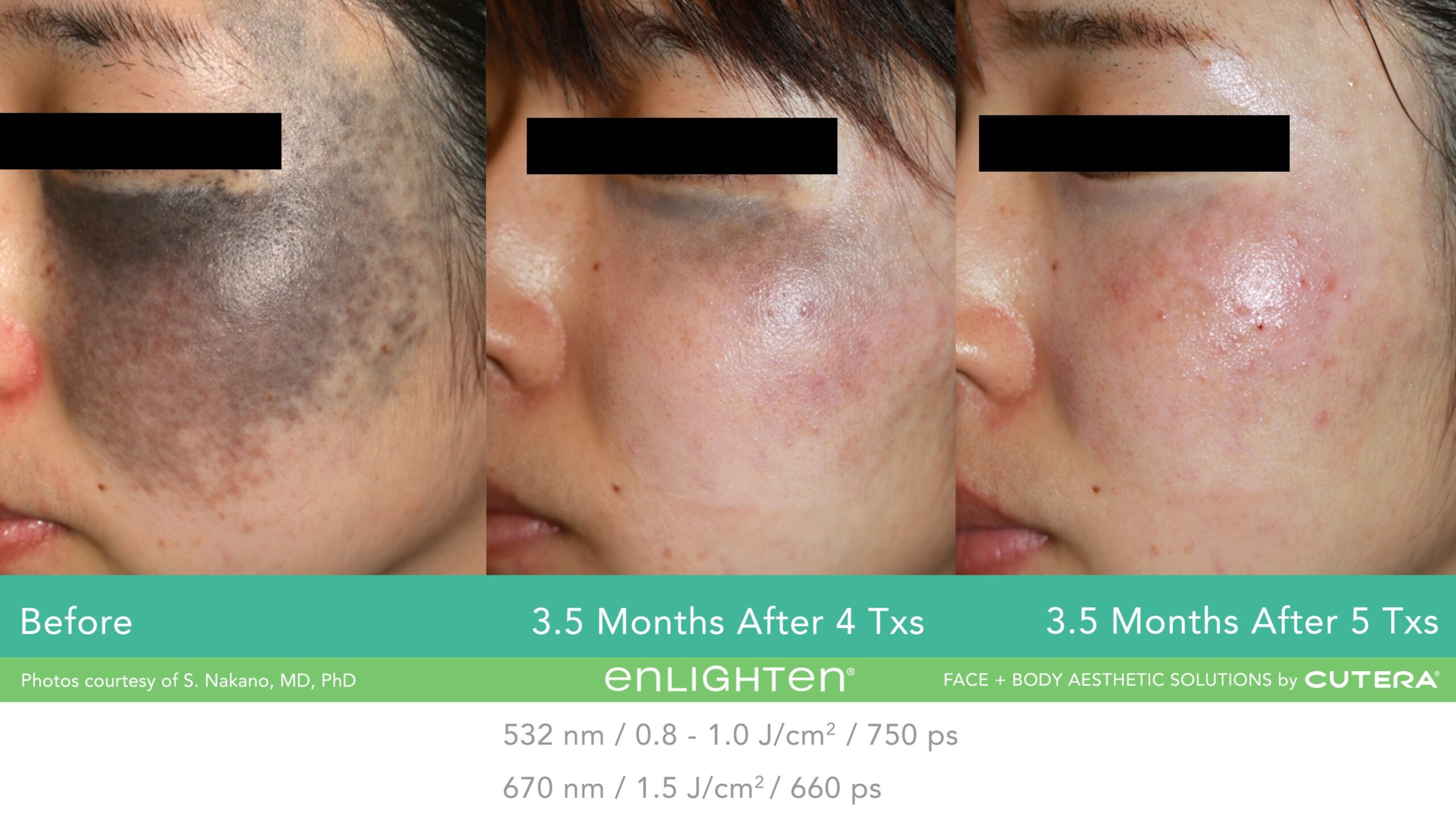 enlighten B&A Photo - Nevus of Ota