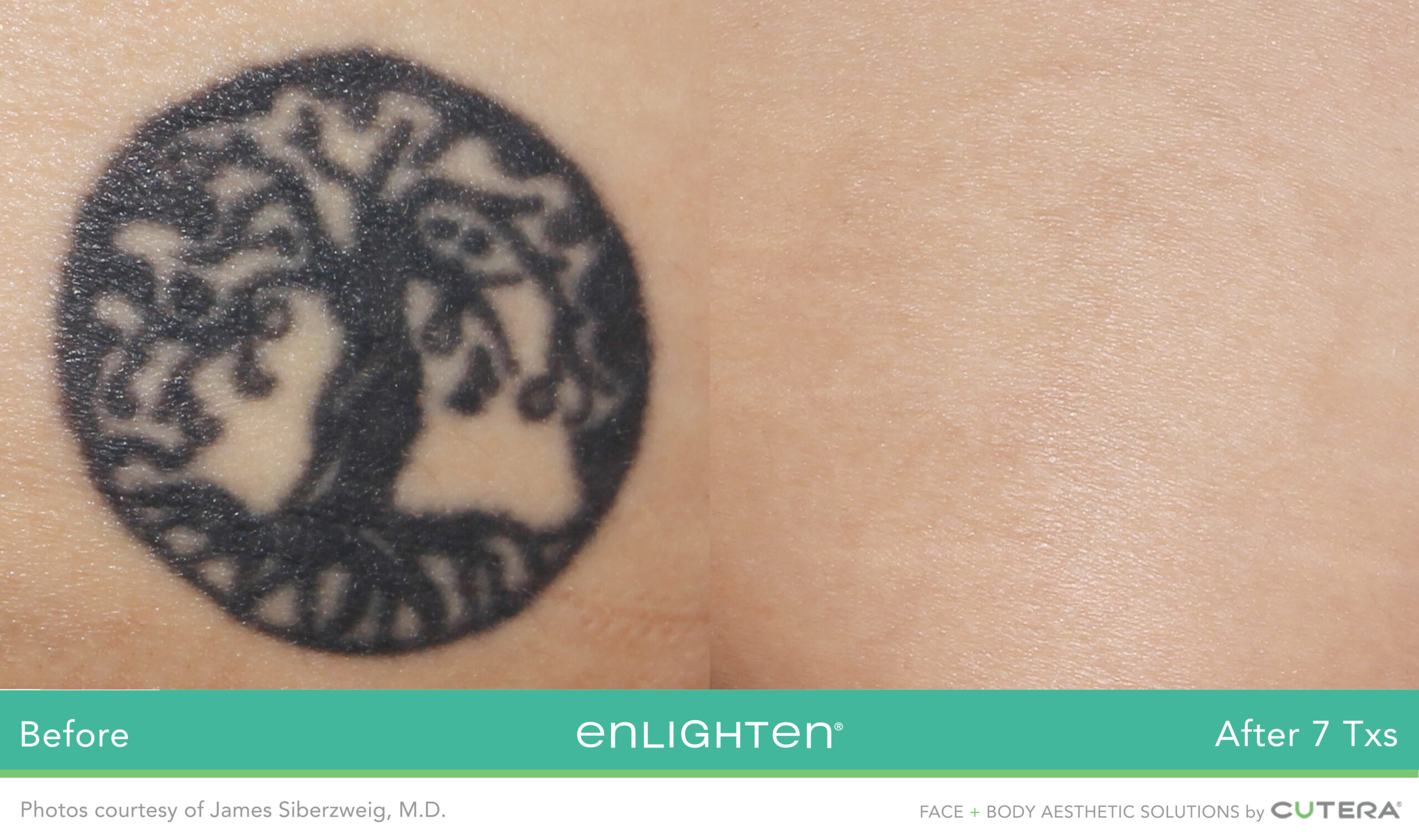 Avant après détatouage arbre