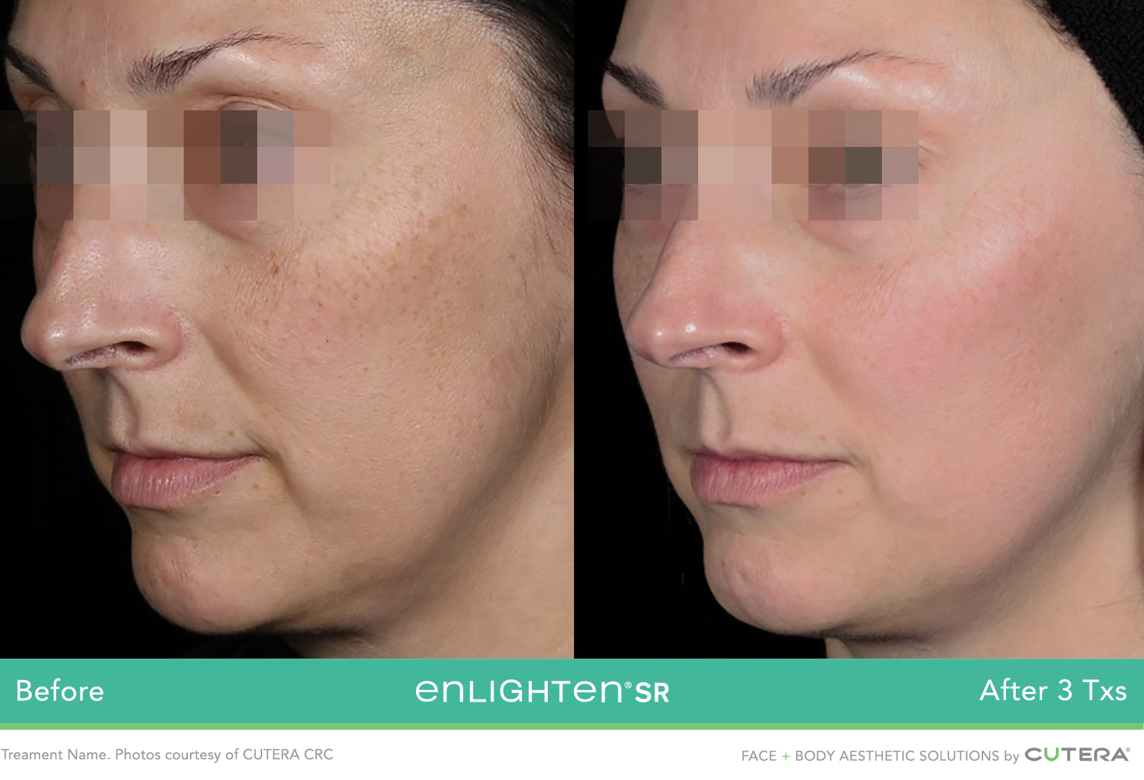 enlightenSR-CUTERA-CRC-P1_highres