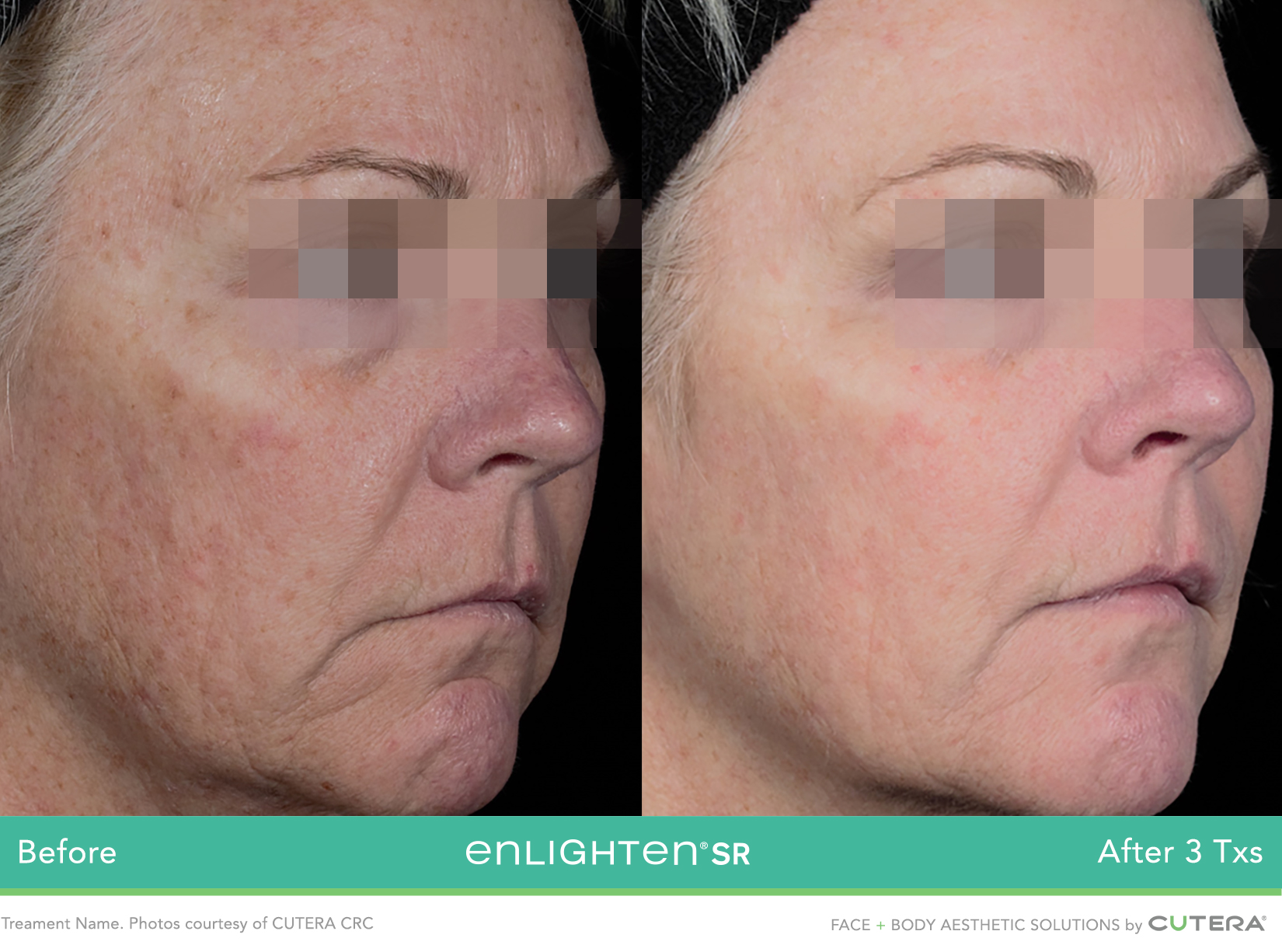 enlightenSR-CUTERA-CRC-P4_highres