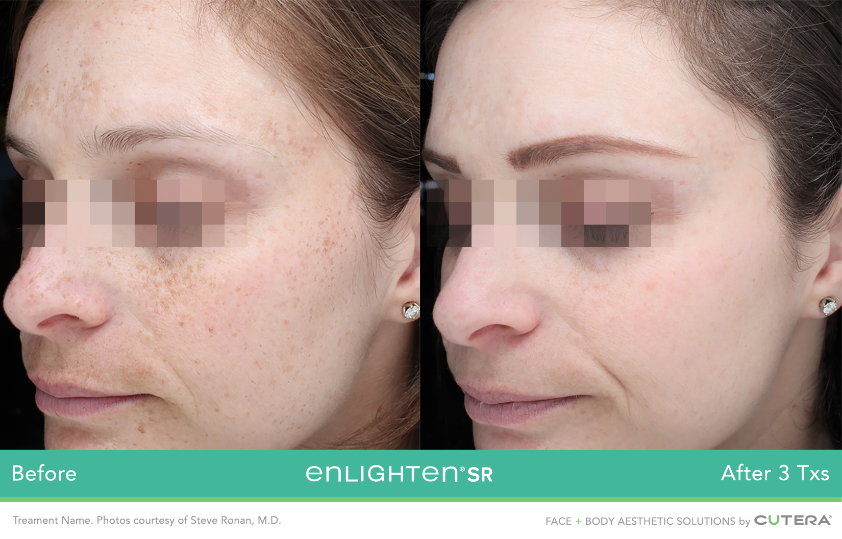 avant après laser taches brunes visage