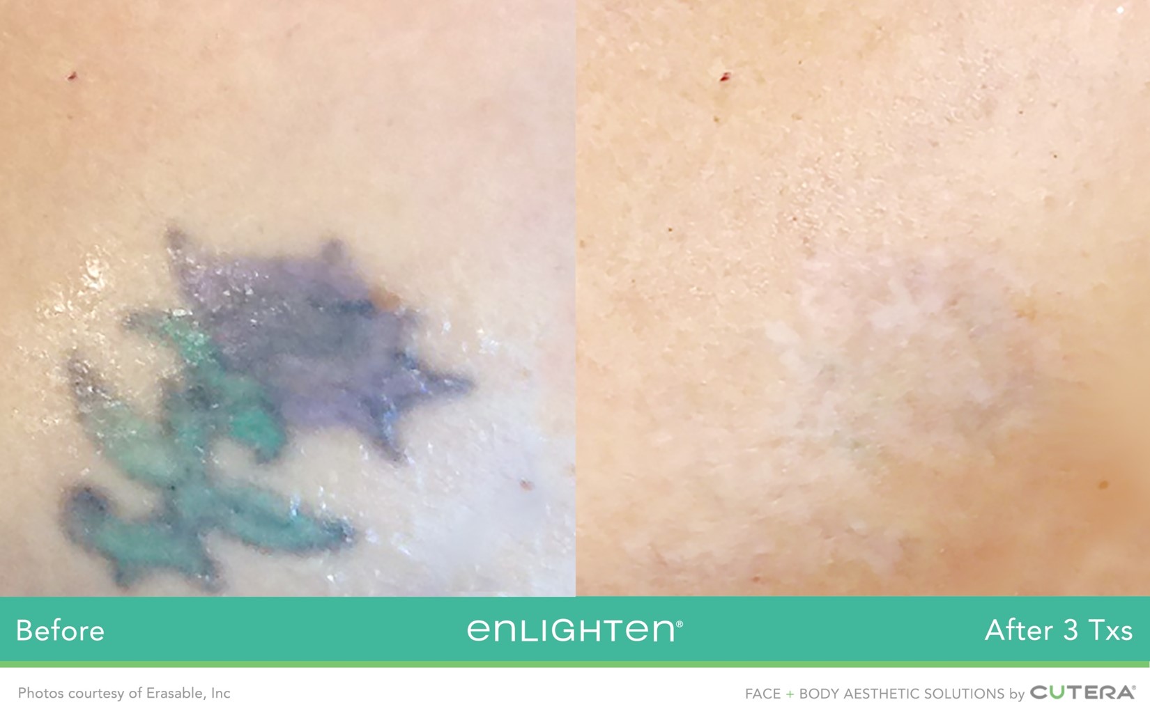 avant après détatouage fleur