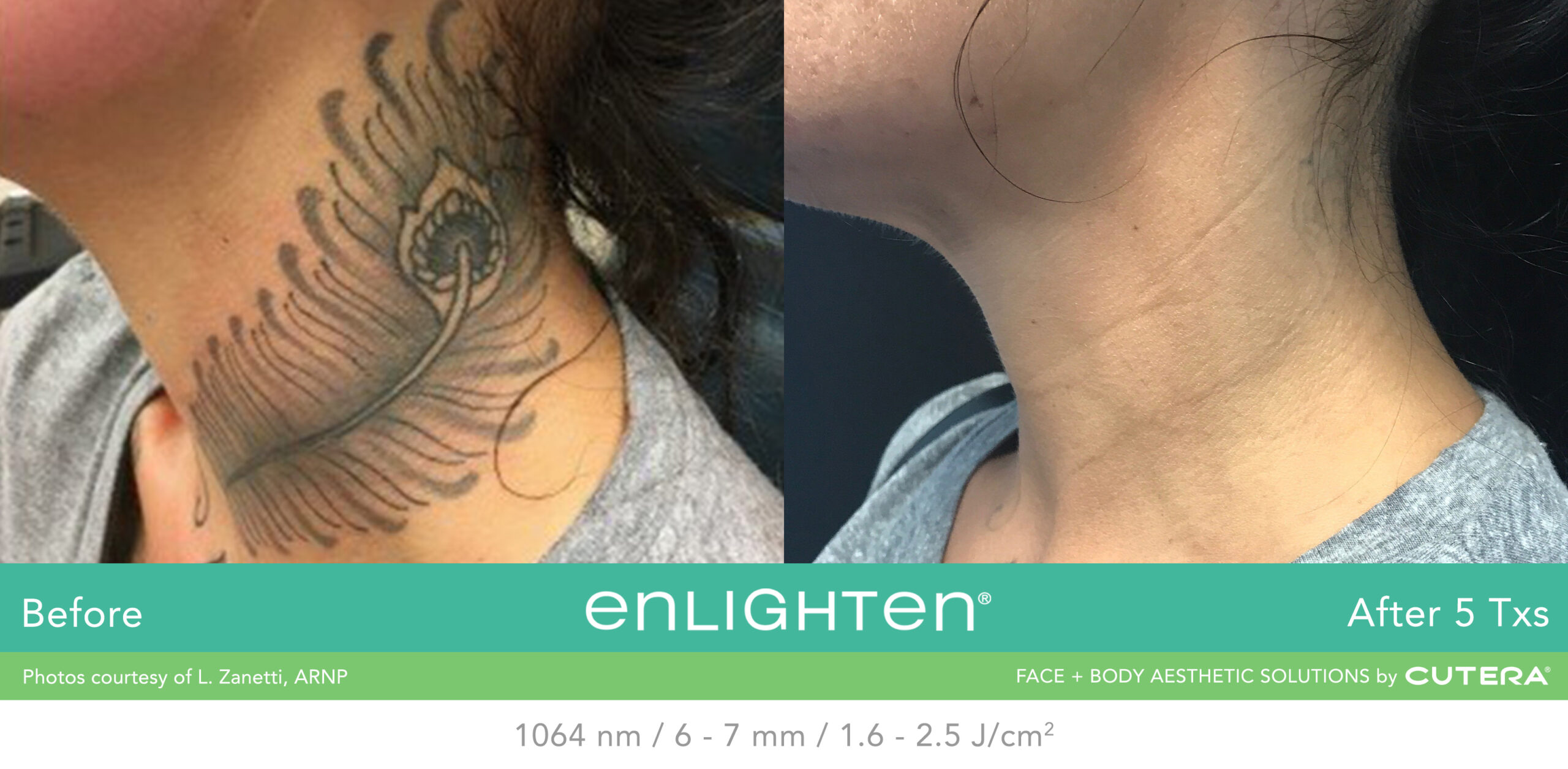 Avant après détatouage laser dans le cou