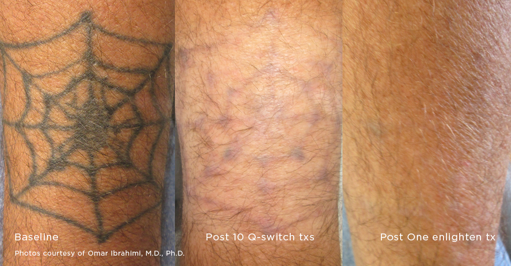 avant après détatouage toile d'araignée