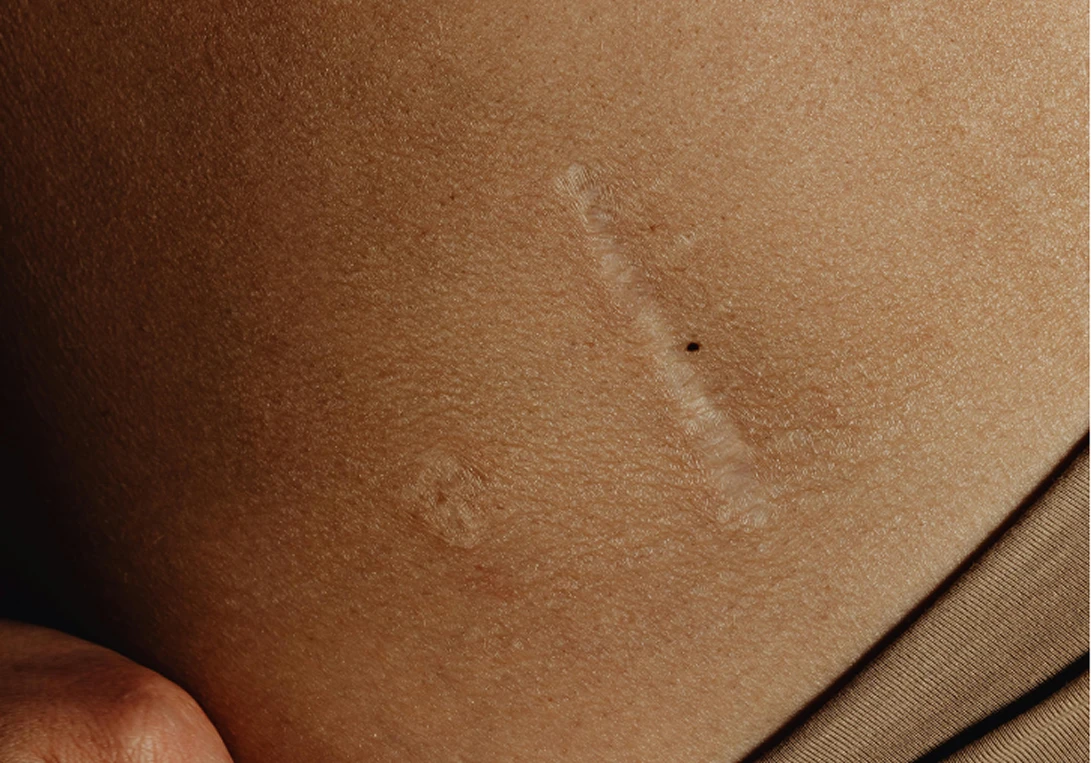 Peau en cours de cicatrisation
