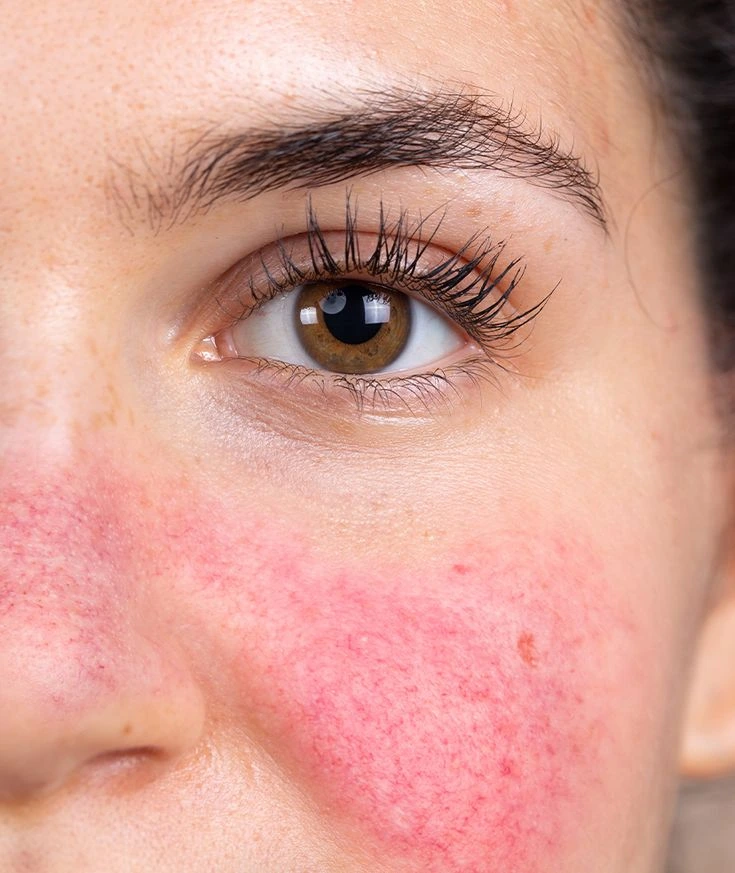 Visage présentant des rougeurs et une rosacée